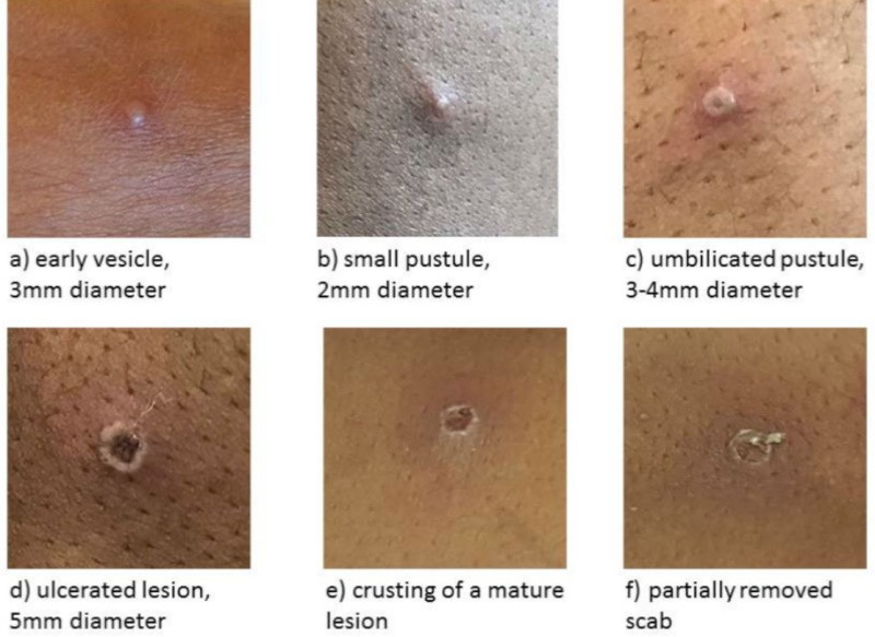 Інформаційний лист щодо реєстрації спалаху віспи мавп в країнах світу